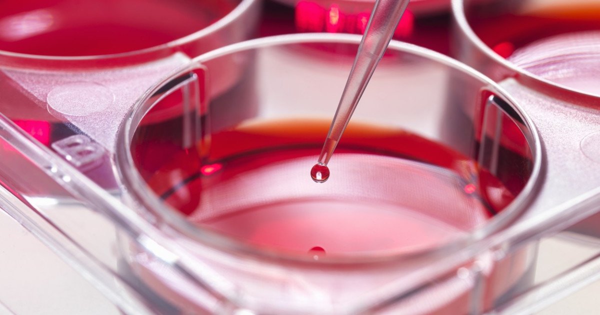 Evoluția leucemiei mieloide acute ar putea fi influențată, conform unui studiu recent, de modul în care celulele stem din măduva osoasă răspund la anumite semnale biologice