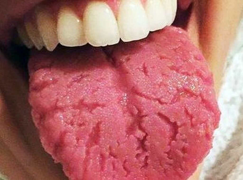 Limba crăpată – un semnal subtil al organismului ce nu trebuie ignorat În lumea medicală, limba nu este doar o porțiune de țesut gustativ, ci și un indicator valoros pentru starea generală a sănătății