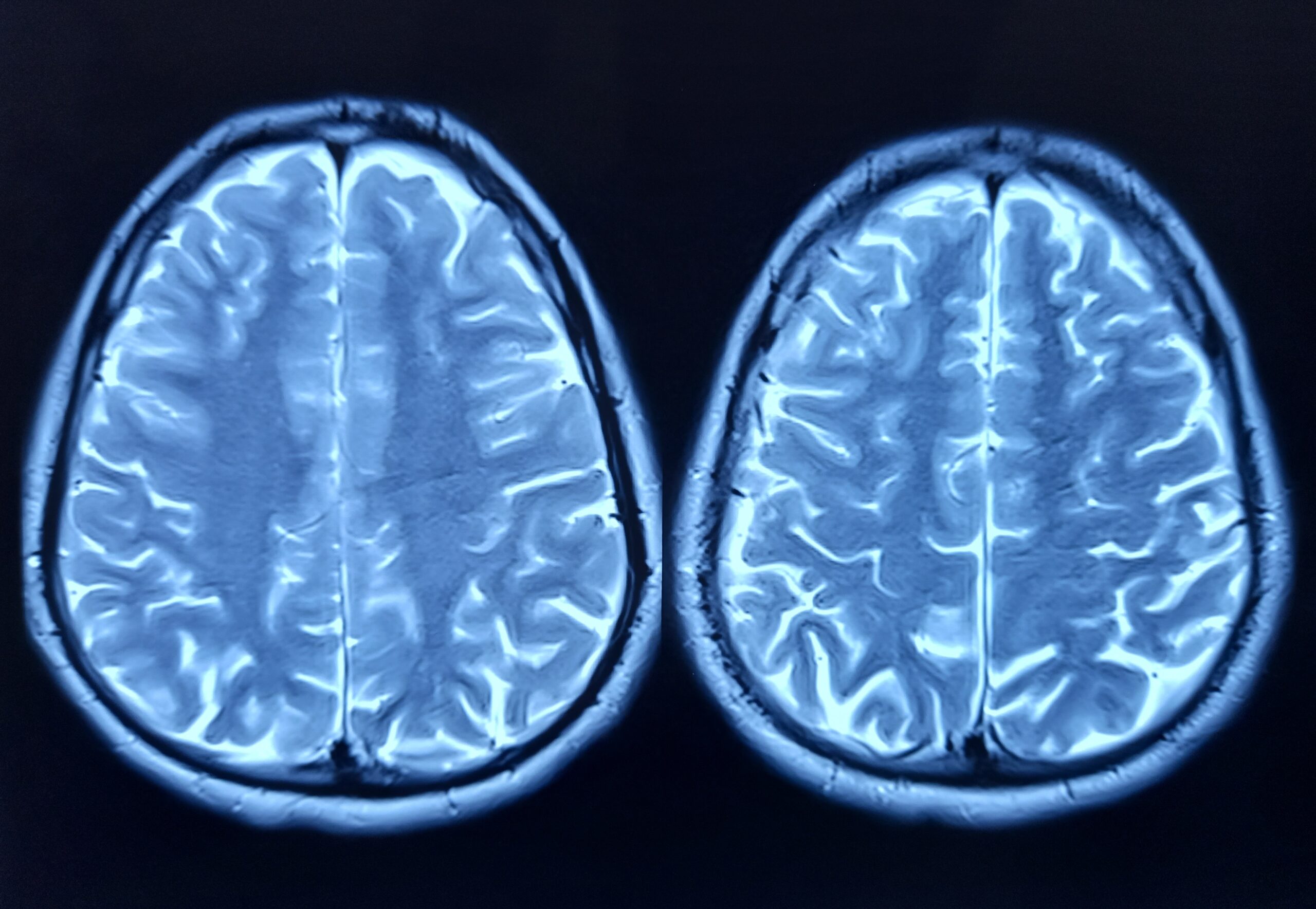 Cercetările din domeniul inteligenței artificiale au făcut un pas înainte remarcabil, odată cu un experiment în care celule cerebrale umane vii au fost conectate la un cip de siliciu, demonstrând pentru prima dată posibilitatea ca neuronii biologici să participe activ la controlul unui joc video complex