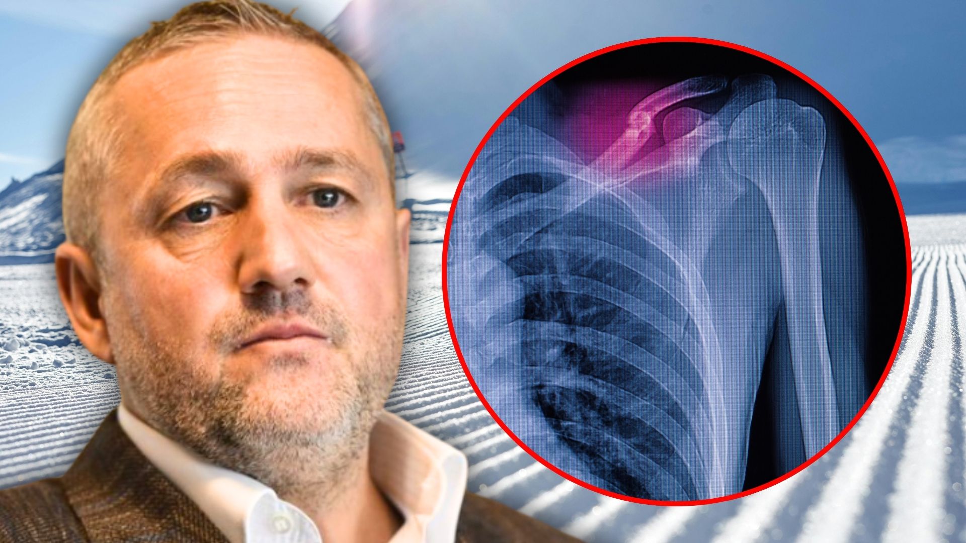 Mihai Rotaru, despre accidentul grav la schi: „Are 8-10 șuruburi în el!”