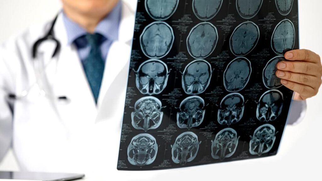 Monitorizarea colesterolului la fiecare analiză de rutină reprezintă o practică frecvent întâlnită, însă specialiștii subliniază că aceasta nu este suficientă pentru o evaluare completă a riscului de accident vascular cerebral (AVC)