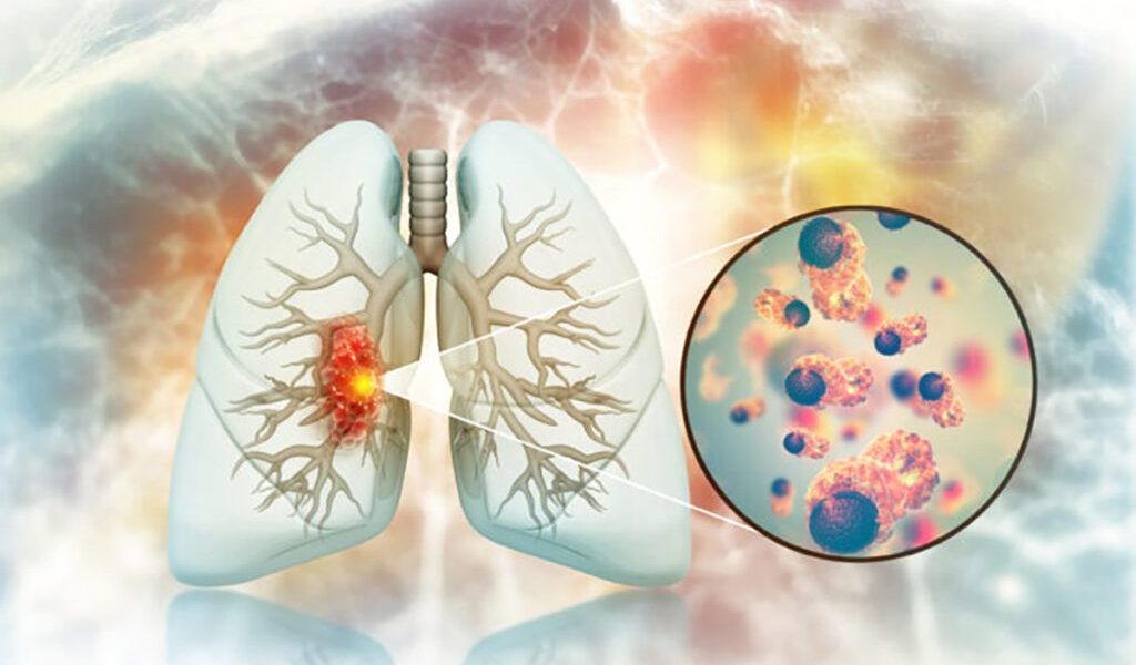 Boală cruntă: Cancer de plămâni la nefumători, legat de fructe și legume