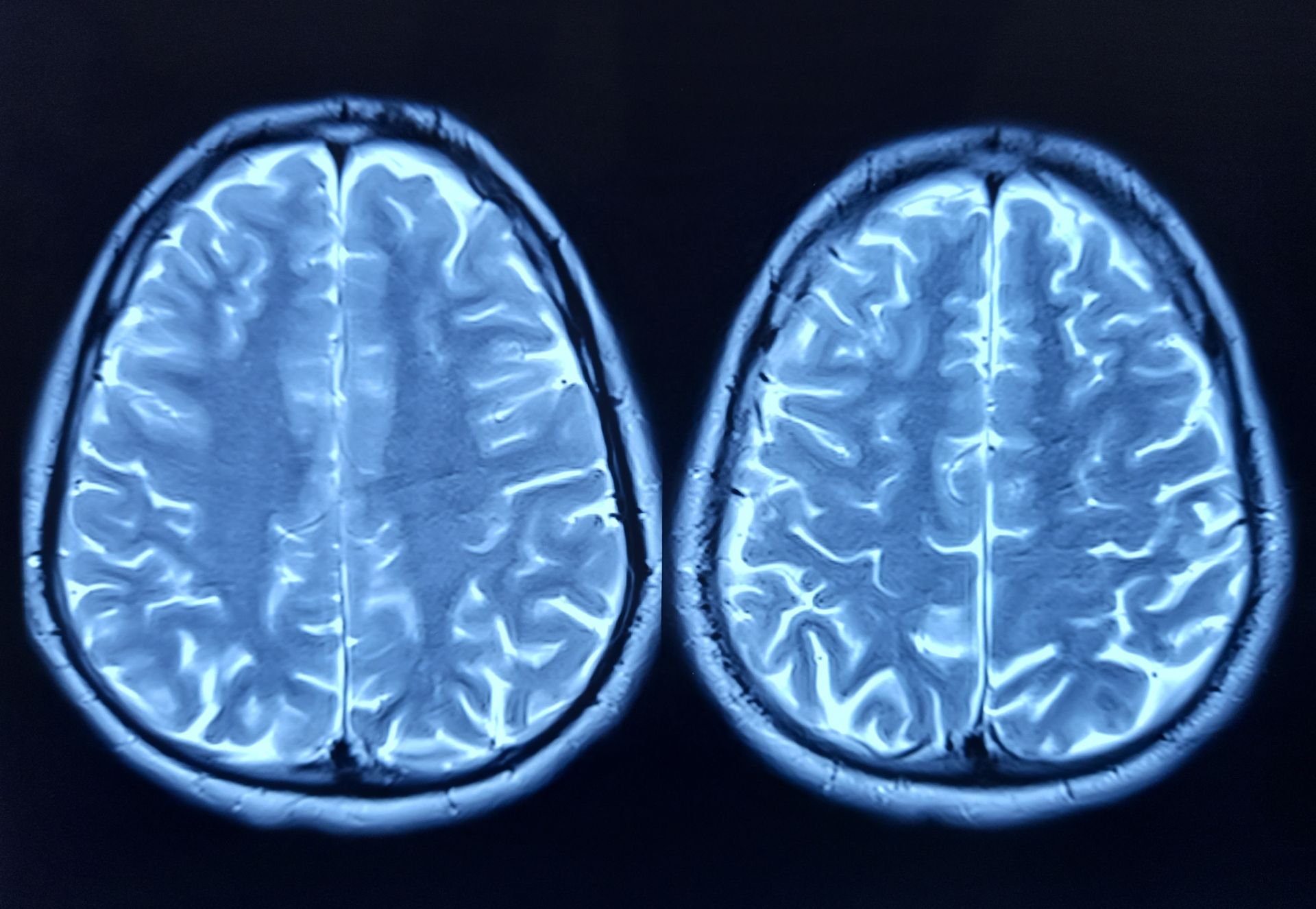 O proteină responsabilă de declinul memoriei și conexiunilor neuronale în creierul bătrânilor Un nou studiu a scos la iveală implicarea unei proteine numite FTL1 în procesul de îmbătrânire cerebrală