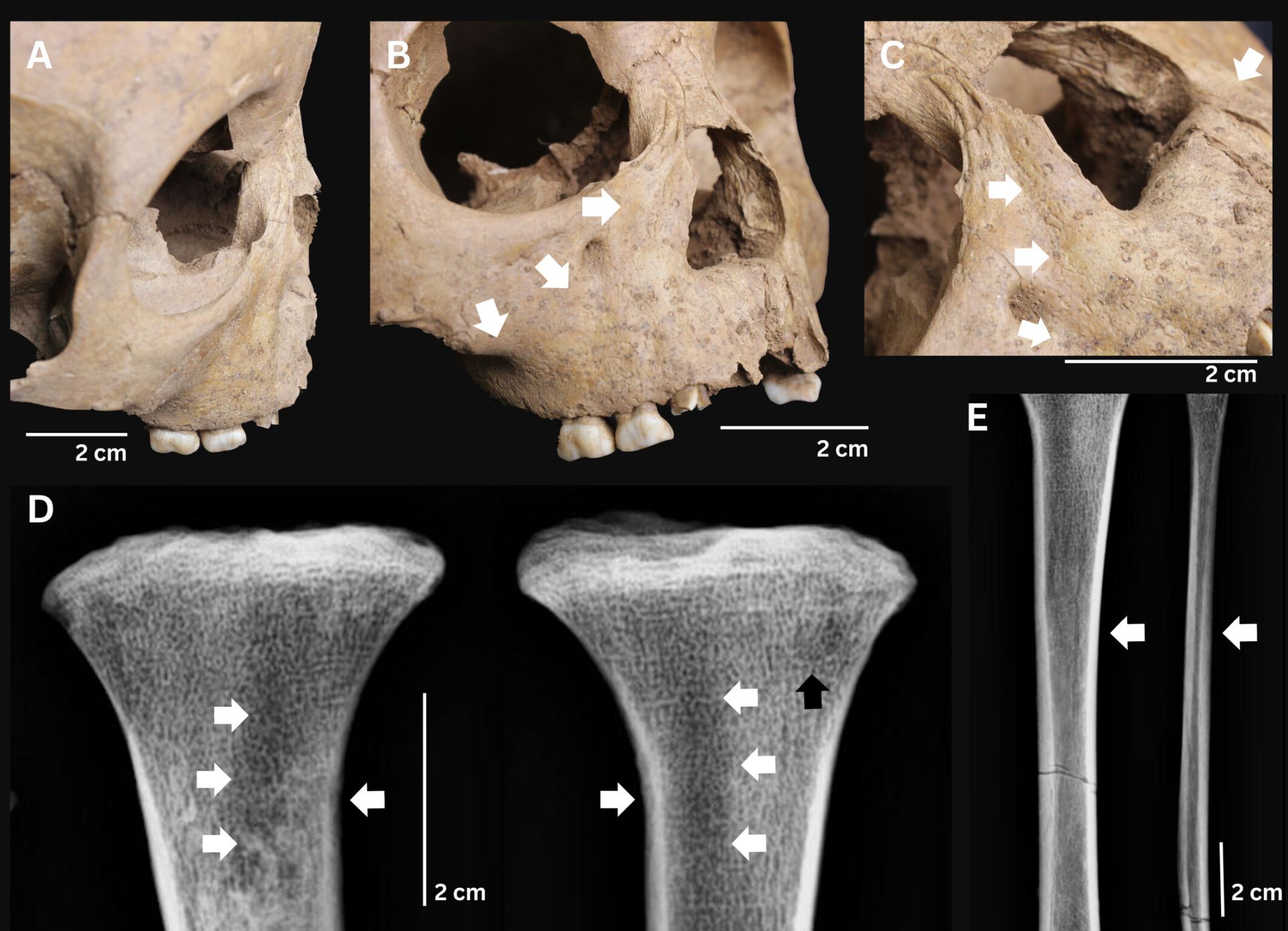 Arheologii din Vietnam au făcut o descoperire care ar putea schimba în întregime modul în care istoria bolilor infecțioase este înțeleasă