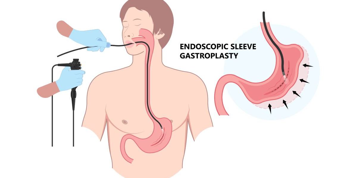 Slăbire fără bisturiu: ESG, revoluția endoscopică în România