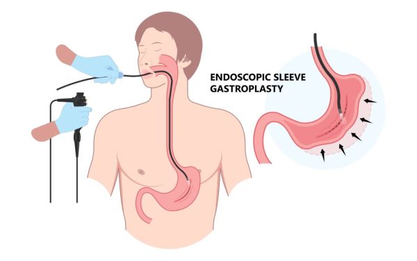 Slăbire fără bisturiu: ESG, revoluția endoscopică în România