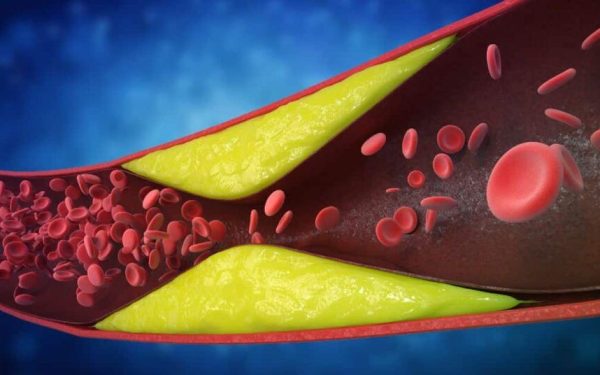 7 semne ignorate: Cardiologii avertizează asupra arterelor blocate