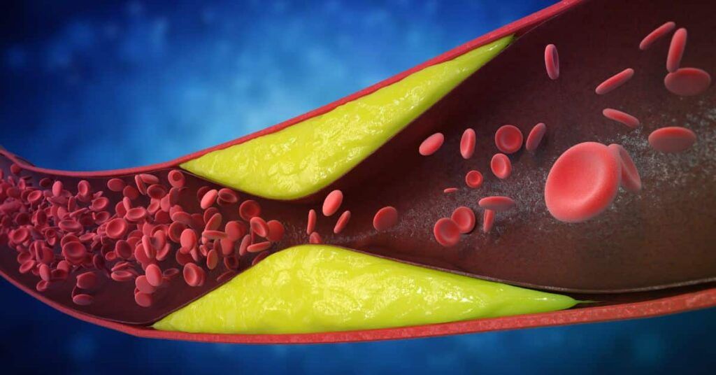 7 semne ignorate: Cardiologii avertizează asupra arterelor blocate