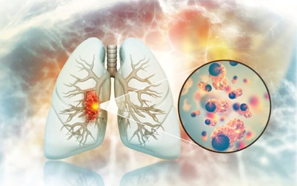 Cancer pulmonar la nefumători: Doctorii, uimiți de cauze