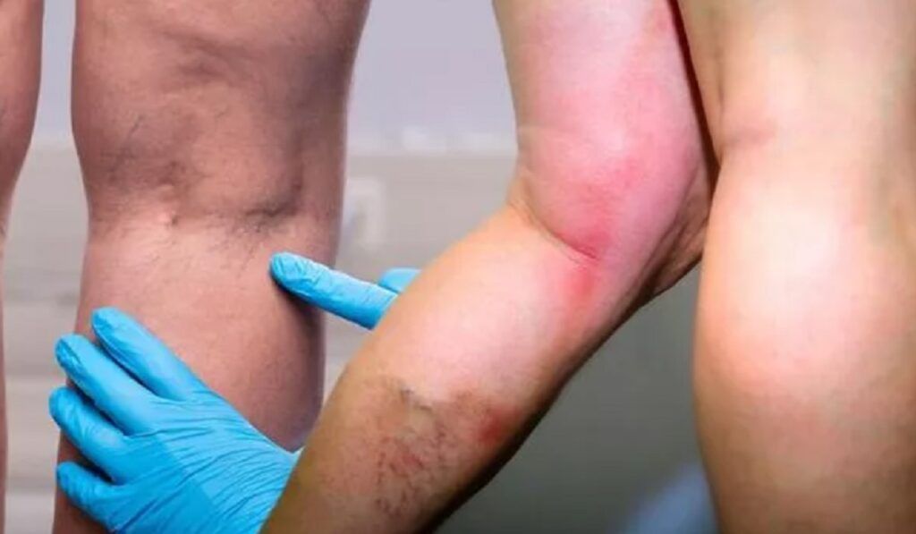 Vitamina-minune: Previne cheagurile de sânge și întărește imunitatea