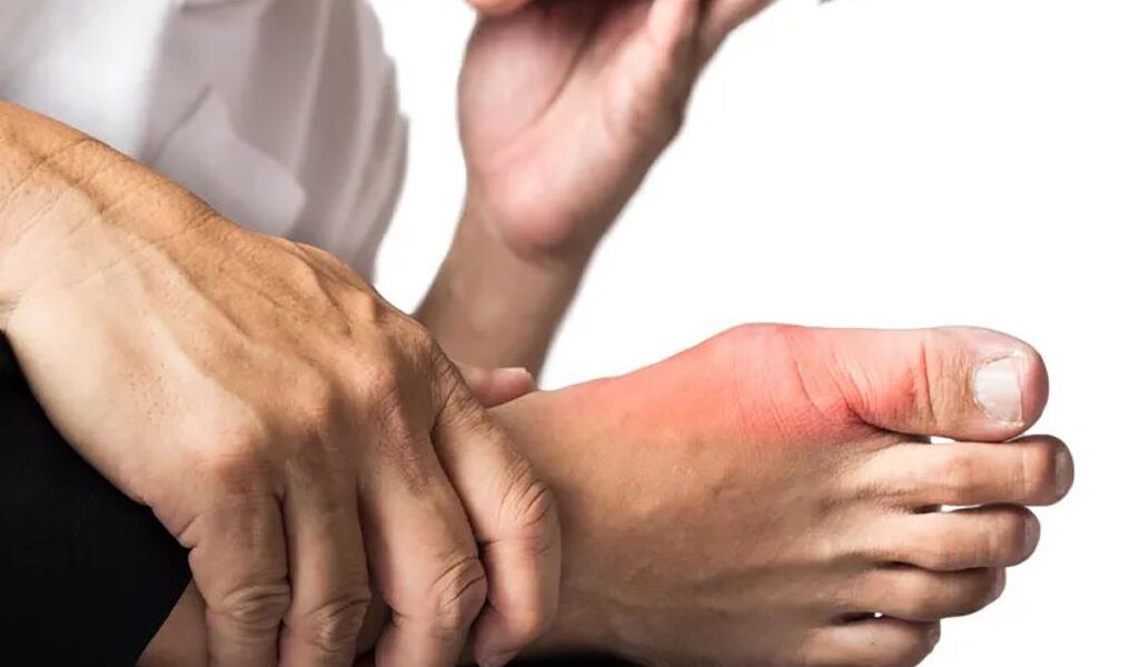 Vitamina-minune: Scapă de gută, reduce acidul uric și calmează durerea