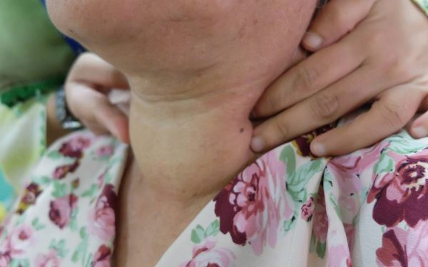 Boala care te umflă, oricât ai țținut dietă