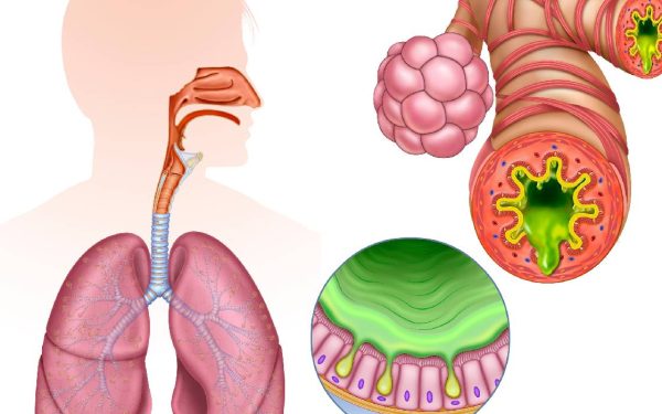 Inflamația cronică, „dușmanul invizibil”: Cum ne amenință sănătatea