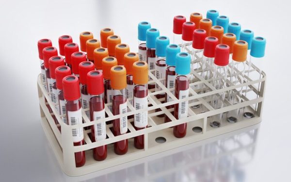 Analiză de sânge revoluționară: Depistează infarctul și AVC mai bine ca colesterolul