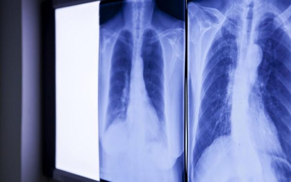 Descoperire ȘOC: Ce au găsit medicii în abdomenul unui bărbat în România
