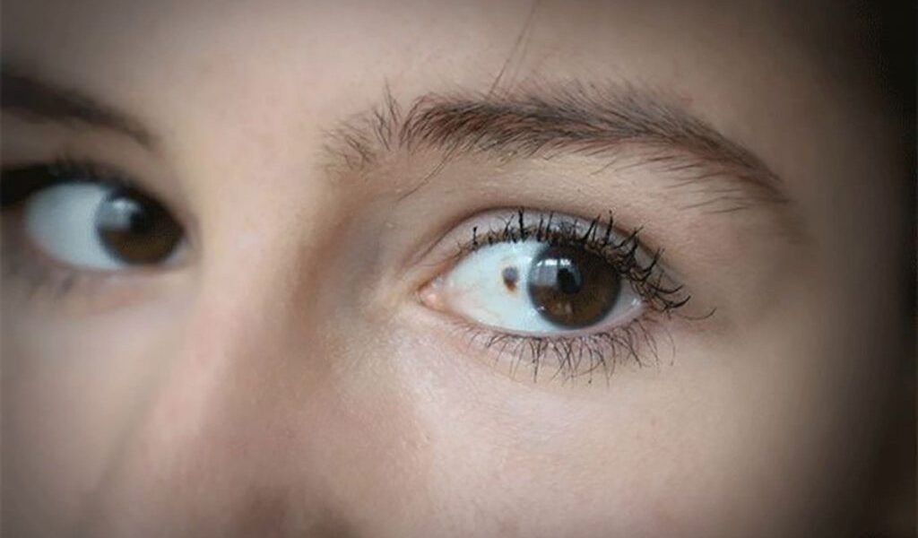 11 semne care trădează cancerul ocular. Vezi ce riscuri ascund ochii tăi