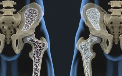 Noul tratament promite oase puternice, chiar și pentru pacienții cu osteoporoză