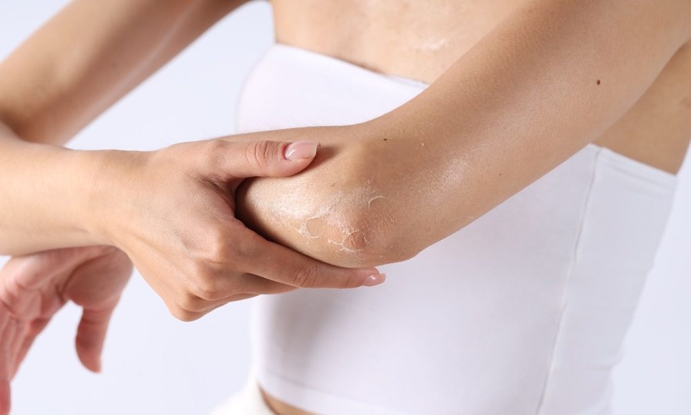 Piele uscată pe brațe și picioare? 5 obiceiuri care usucă pielea