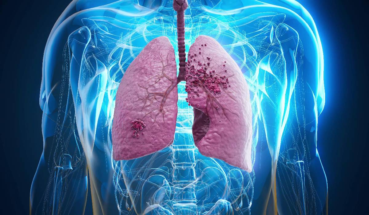 Cancerul pulmonar, una dintre cele mai grave afecțiuni la nivel mondial, ridică întrebări și stârnește numeroase mituri