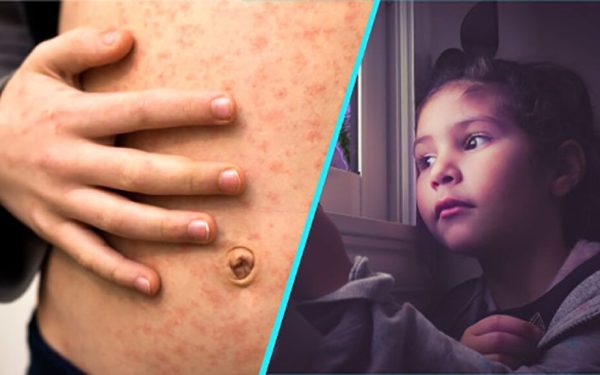 Rujeolă, groaza „uitată”: copii paralizați și uciși, studiu alarmant