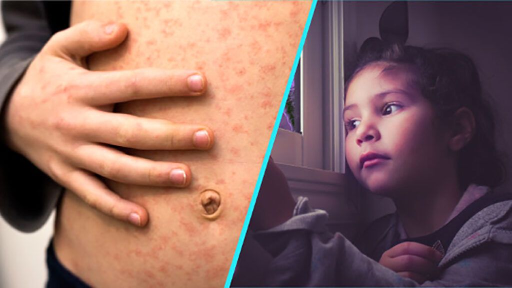 Rujeolă, groaza „uitată”: copii paralizați și uciși, studiu alarmant