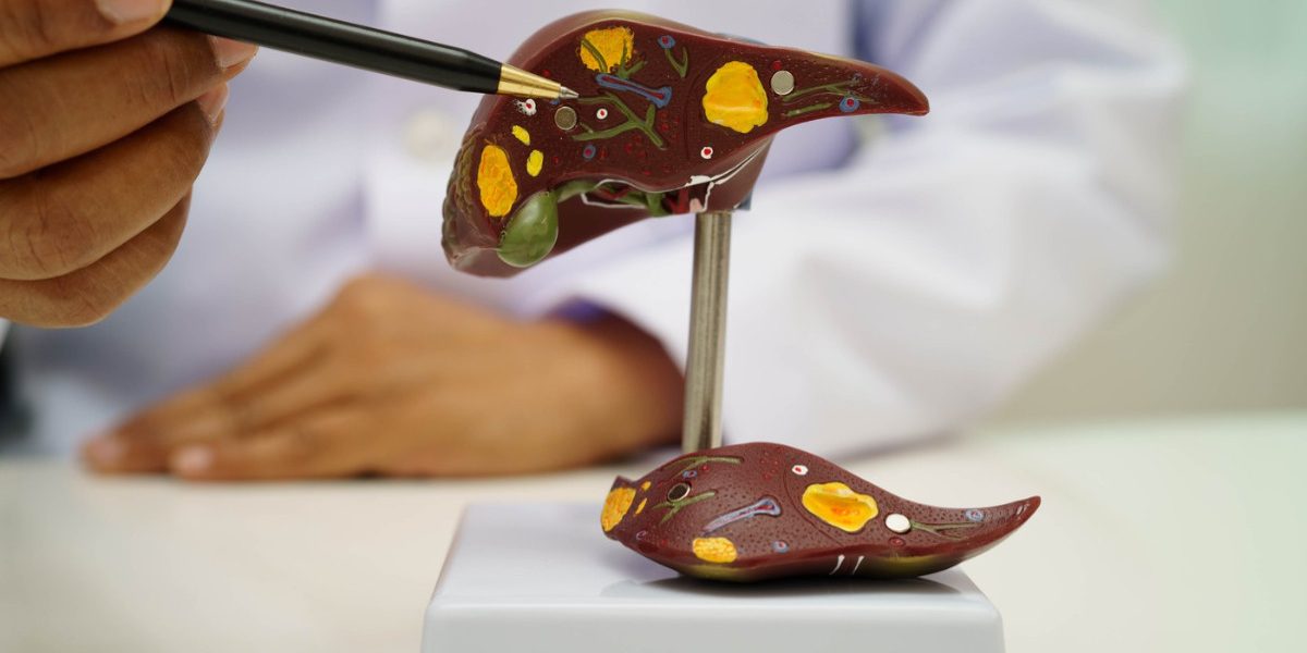 Boala ficatului gras: Atentie la acest „simptom” ascuns, spun medicii