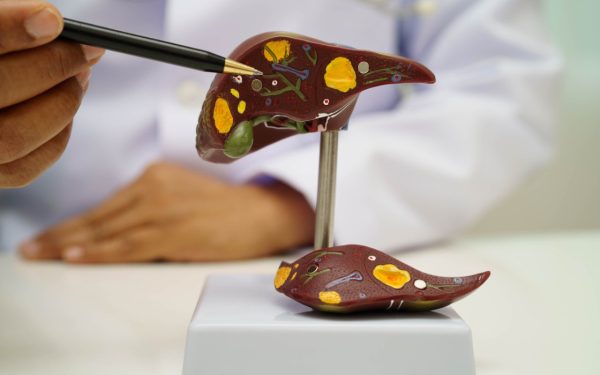 Boala ficatului gras: Atentie la acest „simptom” ascuns, spun medicii