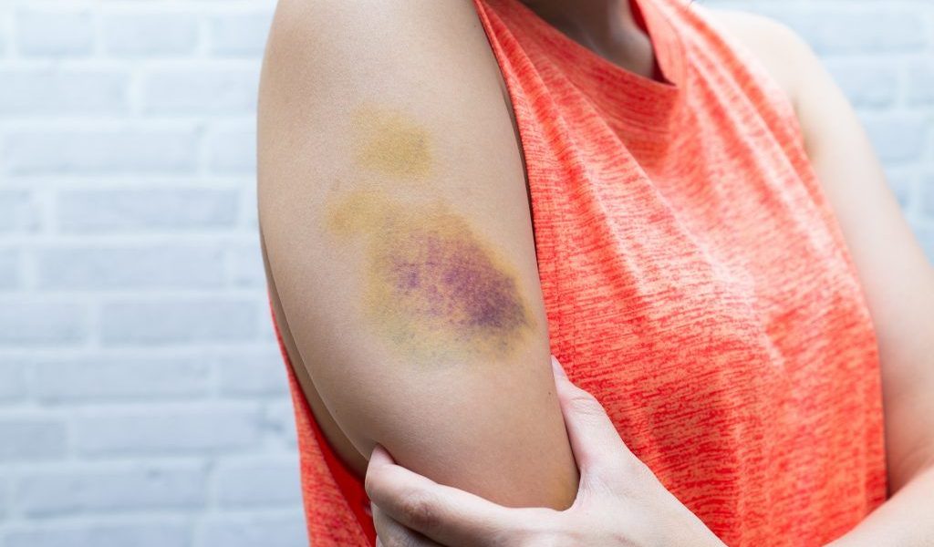 Vânătăile misterioase: Ai probleme de sănătate Dacă apar fără motiv