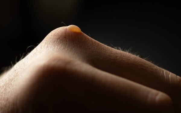 Bășici pe piele: Cauze și remedii rapide