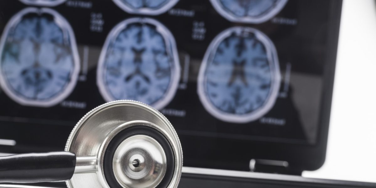 Somnul dezvăluie genele bolii Alzheimer în creier