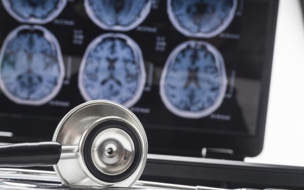 Somnul dezvăluie genele bolii Alzheimer în creier
