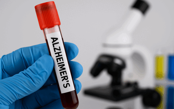 Alzheimer, transmis prin sânge? Șocul unui nou studiu