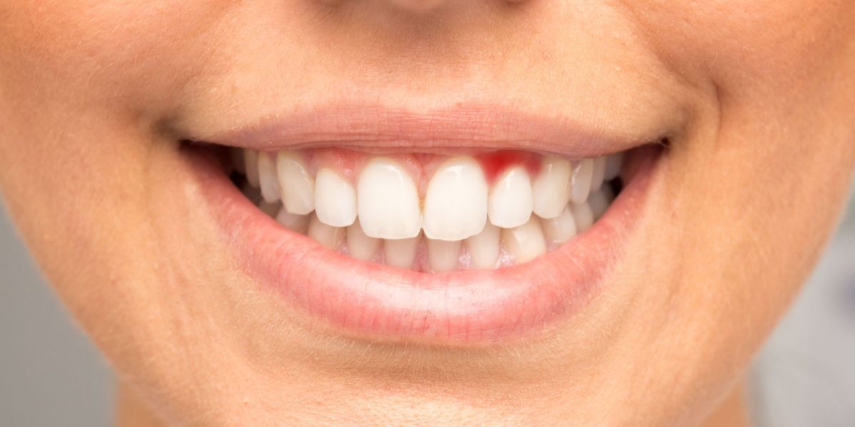 Sângerări gingivale: Atenție la semnul bolii grave