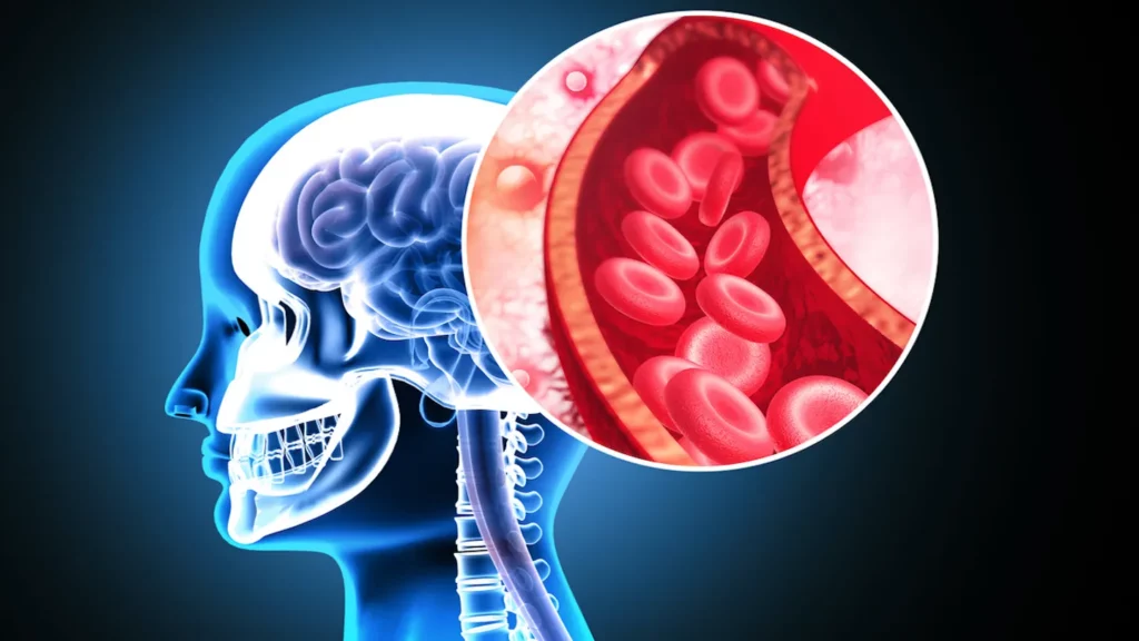 Descoperire medicală: Medicament anti-AVC fără risc de sângerare