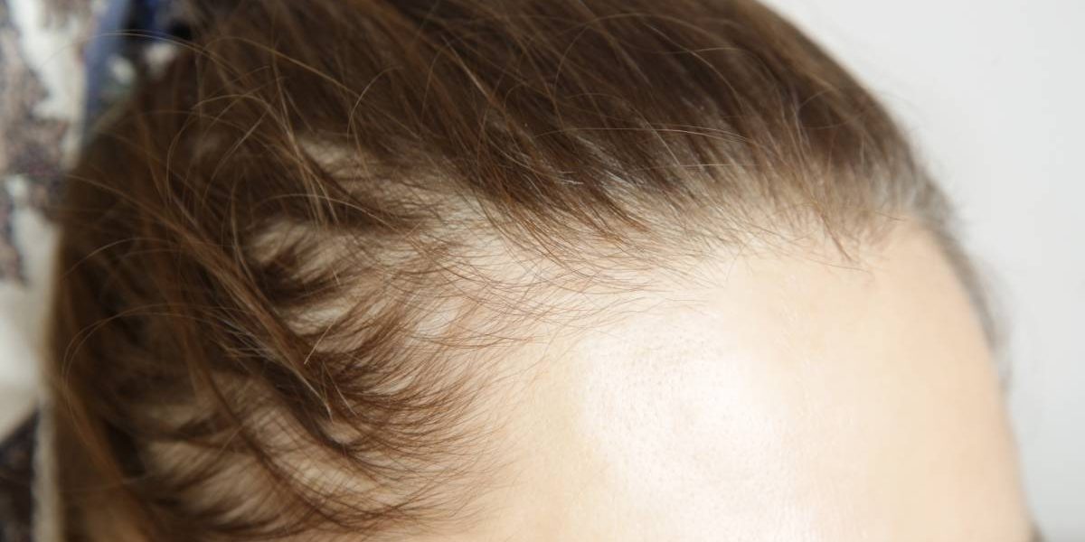 Slăbești și-ți cade părul? Injecțiile cu risc de alopecie