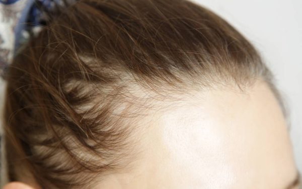 Slăbești și-ți cade părul? Injecțiile cu risc de alopecie