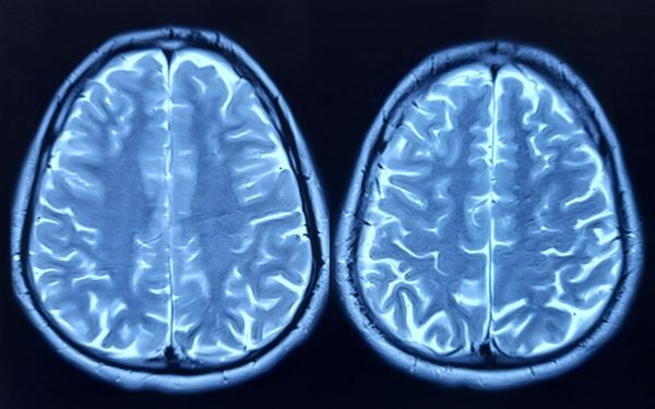 Depresia blochează noi neuroni în creier