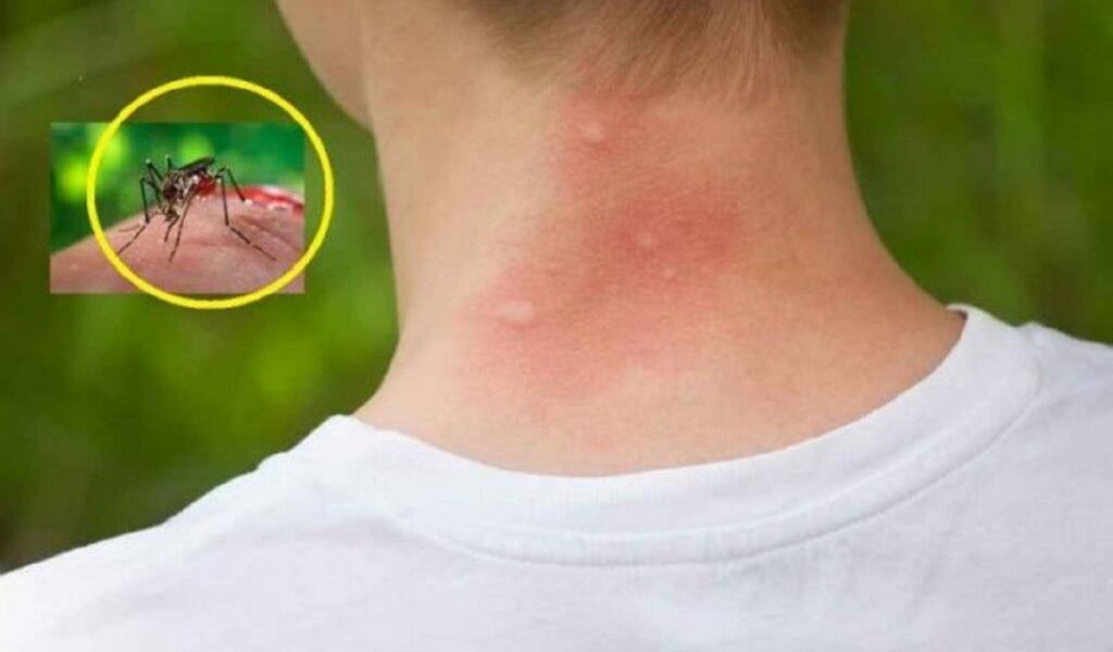 Țânțarii te preferă? Află ce 3 bacterii îi atrag