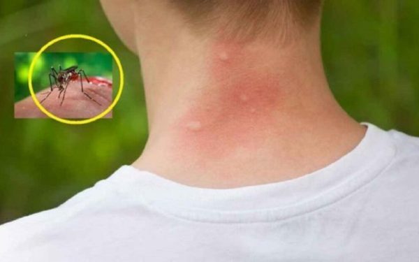 Țânțarii te preferă? Află ce 3 bacterii îi atrag